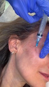 Benefits of #Sculptra: * It’s minimally-invasive and non-surgical —...