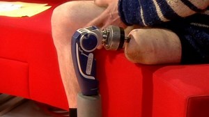 Prosthesis advance offers new hope for amputees