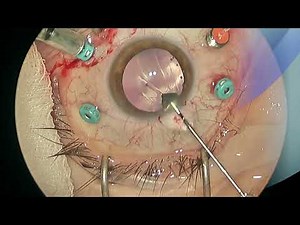 Logical approach to IOFB (Intraocular Foreign Body) treatment