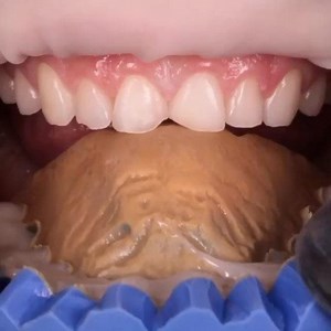 Mock up - temporary veneers  . . . Case by @enrique_diazguzman | Dentistry blog | Facebook