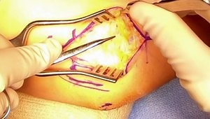 UCL Repair at the Elbow with Internal Brace Augmentation