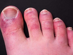 'COVID toe' a result of body's misplaced effort to contain coronavirus: study