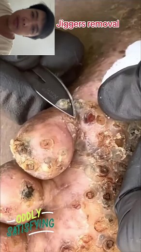 Jiggers removal #jiggers #jiggersremoved #satisfying #satisfyingcleaning #clean #removal #foot #parasite #asmr #usa #poorpeople #poorbaby #amazing #respect #usa_tiktok #usa🇺🇸 #CleanTok #unitedstates