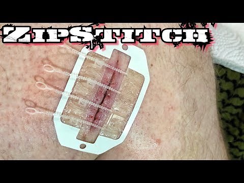 ZipStitch | World's Most Advanced Wound Closure Device!