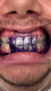 70K views · 569 reactions | Freshmile Mexico on Reels | Facebook