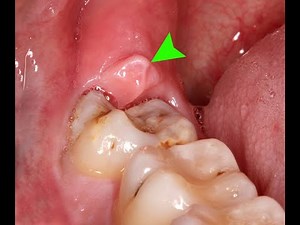 Pericoronitis | Swollen gums | Gums Inflammation | Pain in gums | #Paininwisdomtooth