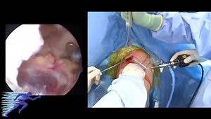 AC Joint Reconstruction with Tibialis Allograft and Dogbone Suture