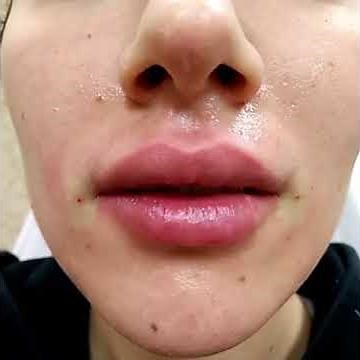 Lip injections with Juvederm Voluma, Blunt Cannula, Long Lasting by Dr. Lebowitz, Long Island, N.Y.