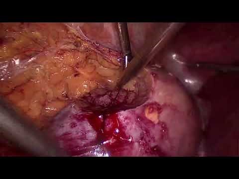 Laparoscopic Partial Nephrectomy for Removal of Kidney Cancer