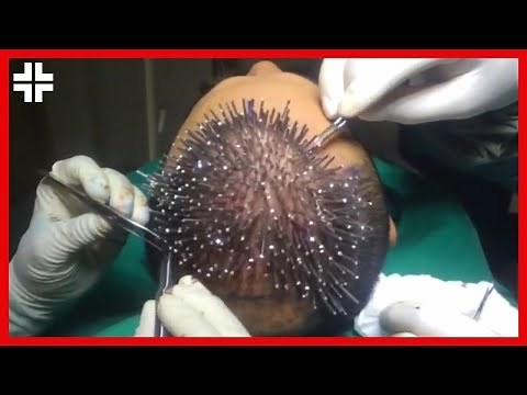 Hair Transplant Surgery 2018