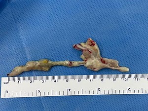 CRYO-EXTRACTION OF MUCUS PLUG