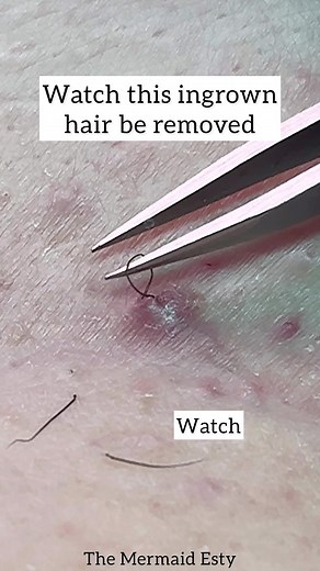Effective Deep Ingrown Hair Removal Techniques and Tips