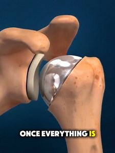 How Total Shoulder Replacement Surgery is Done? (3D Animation) #how #shoulders #surgey #pain #3danimation
