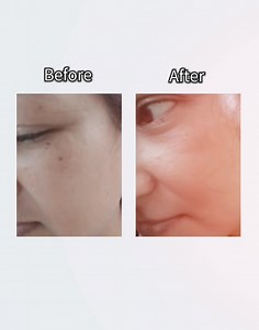 3.3K views · 14 reactions | ⭐Freckles-Free Glow-Up⭐ from cute little freckles to clear, radiant skin #Freckles #freckleface #FreckleRemoval | Surecell Chattogram | Facebook
