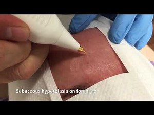Sebaceous hyperplasia removal