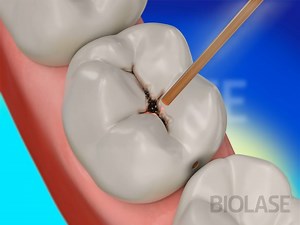 Replace missing teeth or repair damaged teeth with restorative dental treatment using Waterlase, a patented combination of laser energy and water - enabling dentists to perform various procedures and requiring fewer shots and less anesthesia. | Dental Videos | Facebook