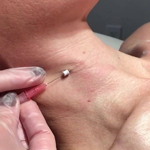 Say goodbye to neckfolds, it's as easy as 1, 2, 3! ・・・ 1. Insert thread 2. Twist needle to release thread 3. Remove needle ・・・ NovaThreads, seen used here, are PDO sutures preloaded onto sterile needles for insertion into the skin for an improvement of fine lines, wrinkles and skin texture.Threads are a simple and effective tool for those looking for a minimally invasive option to correct moderate facial aging. Complimentary consultations are always available! 💉❤️ | Shapiro Aesthetic Plastic Su