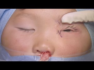 Surgery: External DCR with Canalicular Repair