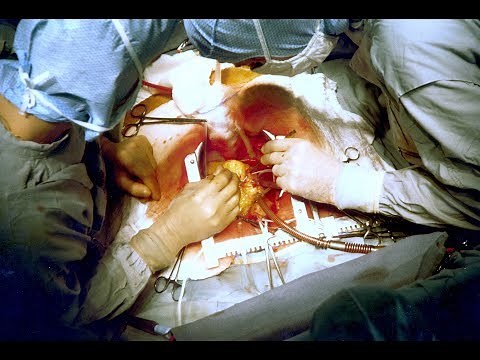 heart surgery Full Video