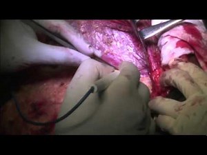 MRM Modified Radical Mastectomy and Level I , II, III ALND for Ca Breast Part 03