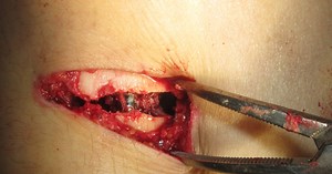 Có thể kéo “chân dài” thêm bao nhiêu cm?