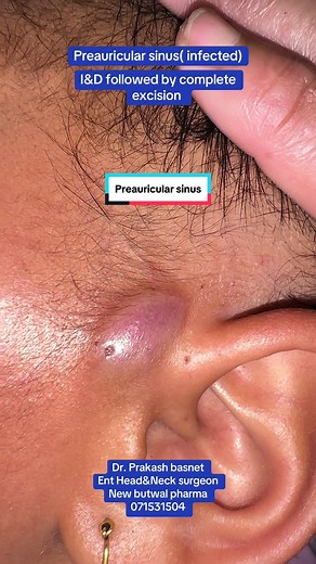 Preauricular Sinus: Causes, Symptoms, and Treatment