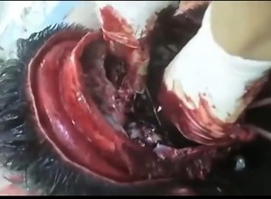 Horrific Brain Removal Surgery