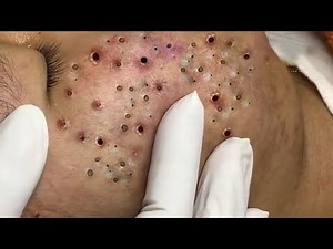 Remove Blackheads and Pimples Popping At HT Spa #35