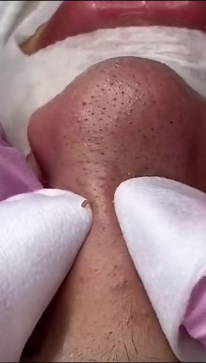 #cravos #brufoli #blackhead #zit #asmr #popping #pimples_brufoli_ #zits #pimples #granos #acne #popper #pimple #pimples_brufoli #granosyespinillas #pimplepop