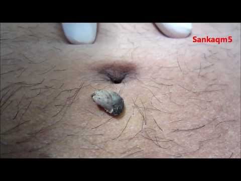WORLD'S DIRTIEST BELLY BUTTON!!! UMBOLITH EXTRACTION/REMOVAL!!!(UMBILICUS STONE/NAVEL STONE)
