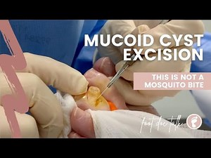 Mucoid Cyst Excision 👀