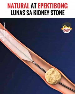 102K views · 1.8K reactions | Ito ang ilan sa mga pinaka-epektibong gamot para sa Kidney Stone. Panoorin at ibahagi.   | No To Sakit | Facebook