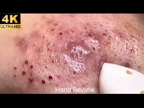 Ultimate Pimple Popping Compilation | Blackheads, Whiteheads & Acne Removal