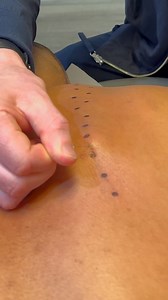 49 reactions |  Dry needling uses a thin filament needle to disrupt dysfunctional motor end plates, reduce nociceptive input, and restore normal neuromuscular function. ‍♂️‍♀️‍♂️ #DryNeedling #ChicagoChiropractor | Dr_kyleross | Facebook
