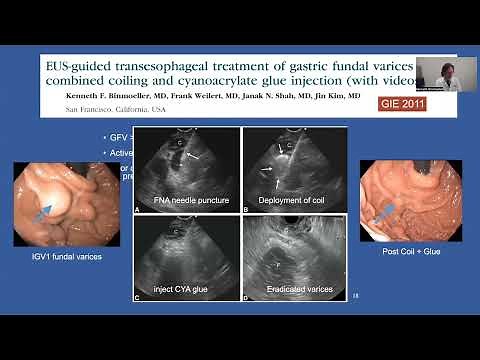 AASLD / ASGE 2022 "Endoscopic Management of Gastric Varices"