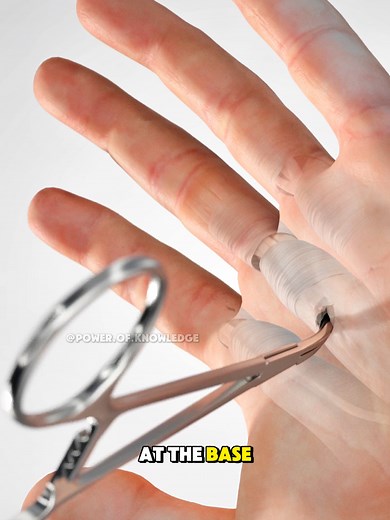 Understanding Trigger Finger Release Surgery Explained