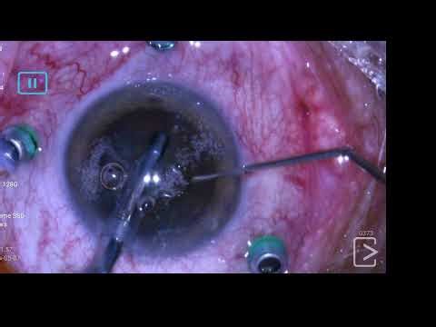 Cataracte et vitrectomie pour membrane épirétinenne.