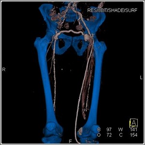 19 reactions | CTA with Bone Removal #ctisus | CTisus: Cutting edge information on body CT (Computed tomography). | Facebook