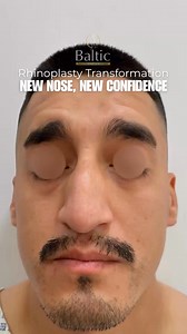 Before & After: Male Rhinoplasty at Baltic SurgeryA refined, natural result that enhances facial balance and boosts confidence — without changing who he is.Our Board-Certified Plastic Surgeons specialize in creating results tailored to each patient’s unique features, ensuring harmony from every angle.📍 Baltic Surgery – Tijuana, Mexico👨‍⚕️ Board-Certified Plastic Surgeons💬 DM us for your FREE virtual consultation#Rhinoplasty #MaleRhinoplasty #PlasticSurgery | Baltic Surgery Tijuana - Bariatric