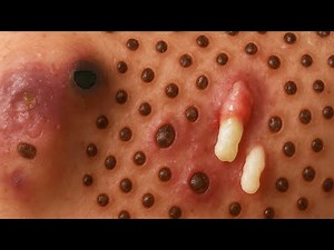Yuki Spa Da Nang's TOP SECRET Blackhead Extraction Technique Revealed!