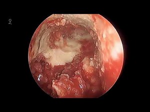 Frontal sinus drill out (Draf III / endoscopic modified lothrop) for severe frontal sinusitis