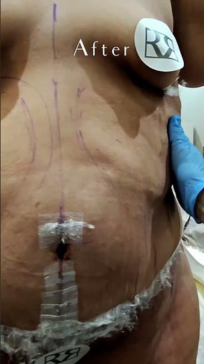 📸 14 Hours Post-Op: Plus Size Tummy Tuck® Transformation ✨