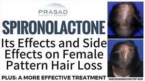 Effects of Spironolactone on Female Pattern Hair Loss and on the Kidneys