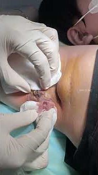 Mụn áp xe to sưng viêm hoại tử ở nách.