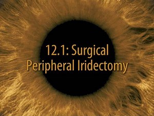 2.1K views · 36 reactions | Surgical Techniques in Ophthalmology Series: Glaucoma Surgery 12. Surgical peripheral iridectomy Edgar U. Leuenberger #Glaucoma_Surgery | Piece of ophthalmology | Facebook