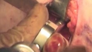 Proximal Biceps Tenodesis - Surgical Options and Techniques