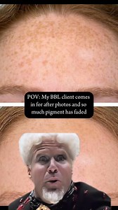 BBL laser working its magic! ✨ After just a few sessions, so much pigment has faded, revealing brighter, more even skin. Bye-bye, sun damage—hello, glow! ☀️✨ #BBLLaser #FlawlessSkin #GoodbyeSunDamage | Blue Halo Med Spa | Facebook