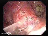 Severe case of Ischemic Colitis (9 of 19) • Video • MEDtube.net
