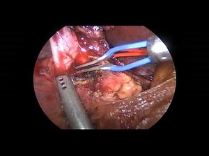 Laparoscopic Excision Of Type Ic Choledochal Cyst With Hepaticojejunostomy Reconstruction • Video • MEDtube.net