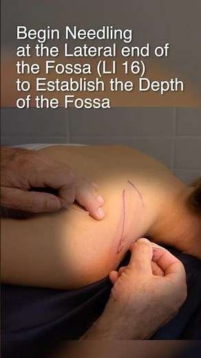 How to Needle the Supraspinatus Muscle – Ashi Acupuncture